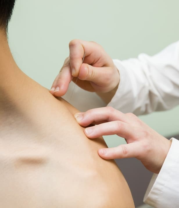 acupuncture